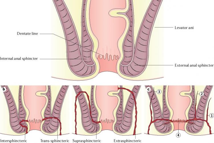 جراحة أمراض الشرج