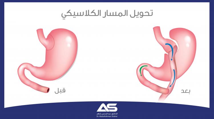 جراحة تحويل المسار الكلاسيكية Roux-en-Y  وصفها وخطواتها، ومراحل ما قبل وبعد العملية